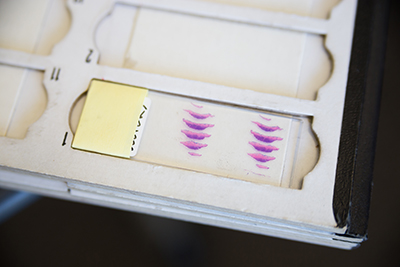 Thin layers of affected skin removed during a Mohs Surgery