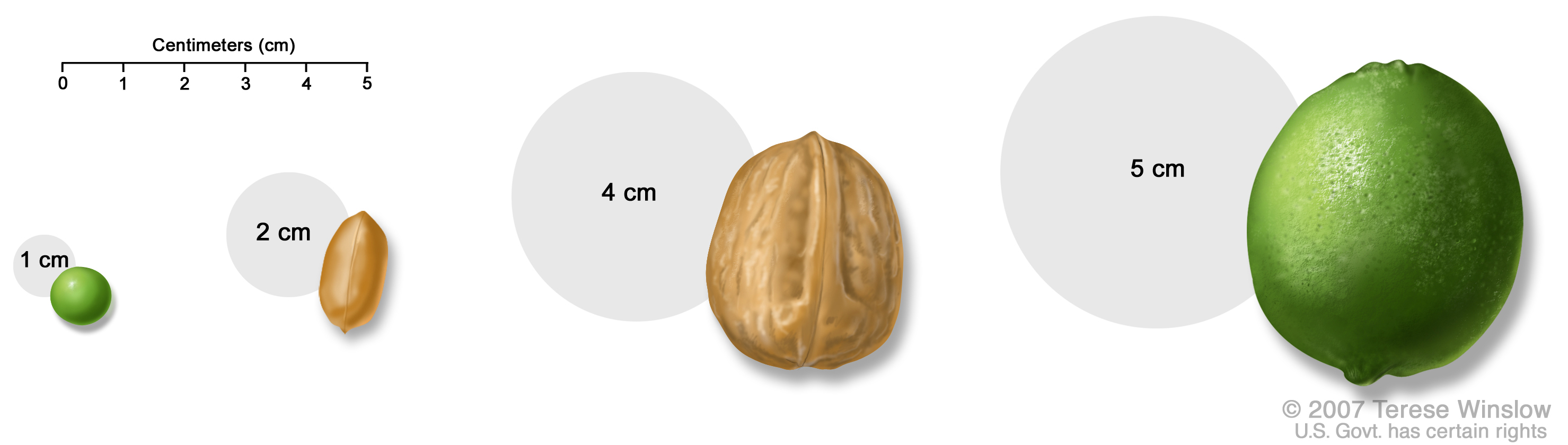 Medical Illustration of Tumor Sizes, full size
