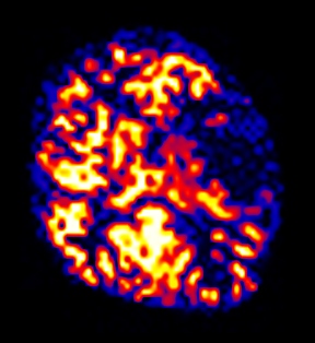 Arterial Spin Labeling MRI Perfusion image B for Radiology