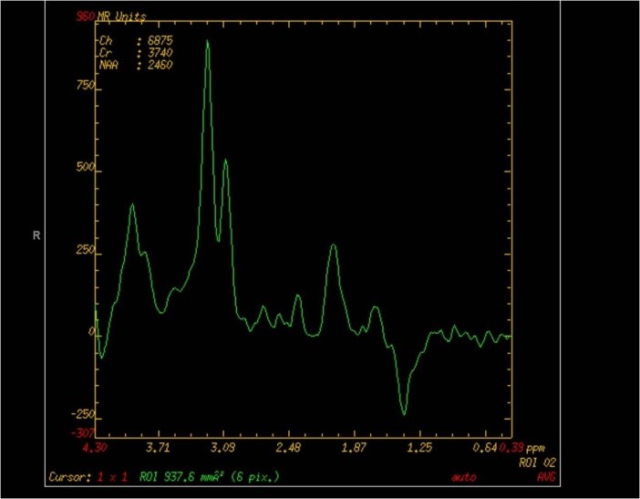 MRI Spectroscopy graph for Radiology