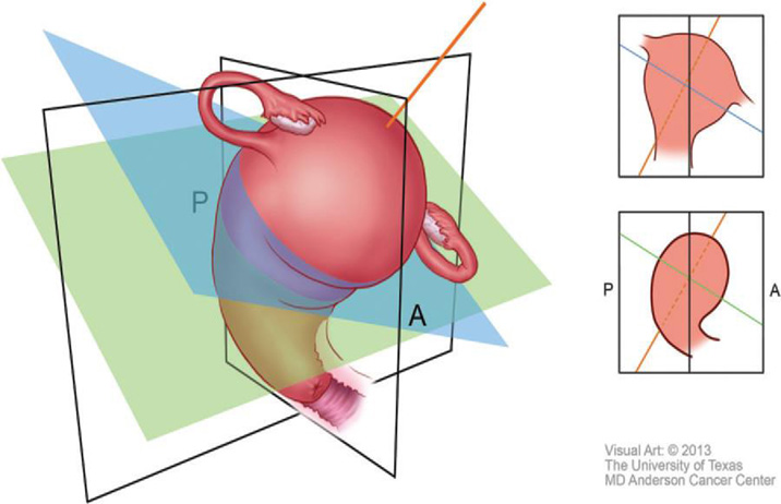 RadioGraphics 2014; 34:1082–1098 Figure 2. Obliques. Illustration shows a uterus that is ante¬riorly rotated in the sagittal plane (anteverted) and laterally tilted to the left in the coronal plane. The double oblique sequence is performed by an¬gling images anteriorly in the sagittal plane (green line) and laterally in the coronal plane (blue line), which creates true oblique images along the true axis of the uterus (orange line). A = anterior, P = posterior.