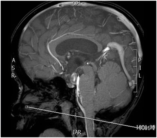 MR Cine Brain CSP LSP