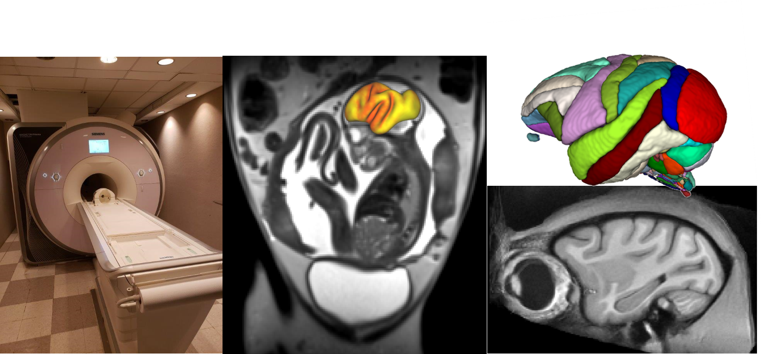 MRI scanner and examples of brain scans