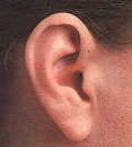 Completely in Canal hearing aid