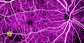 Image of retinal neovascularization taken with OCTA technology at Casey.