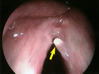 Vocal Polyp