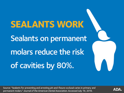 OHSU Dental Clinics Sealants