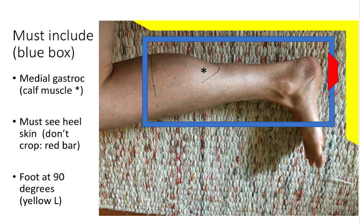 Meeker Achilles Coverage example for MRI Protocol
