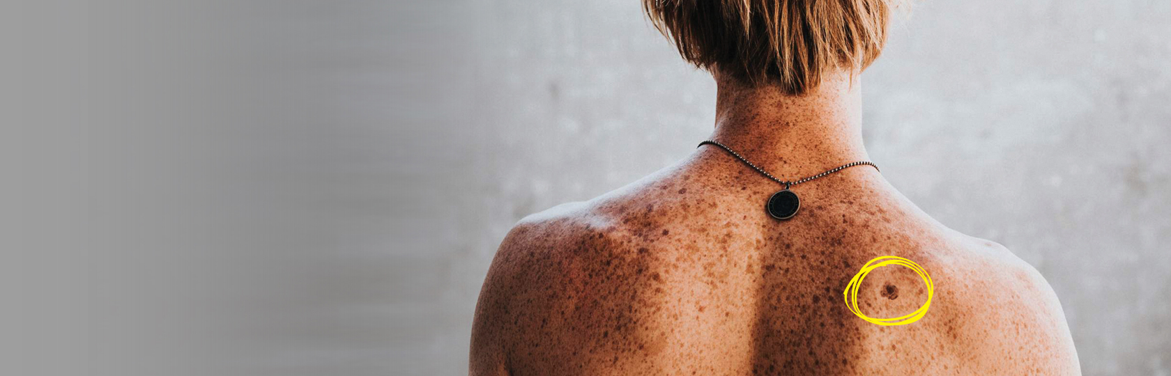 A man with many spots on his back has a mole circled to indicate something potentially harmful