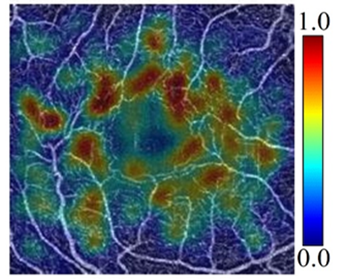 OCTA images of diabetic retinopathy captured by the Casey Reading Center