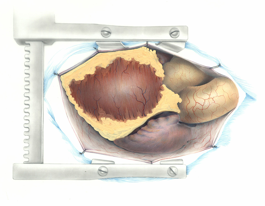 Color illustration: Proper exposure of the heart in an inverted-T fashion (back), undated. Fred Harwin Collection [2022-014]. 