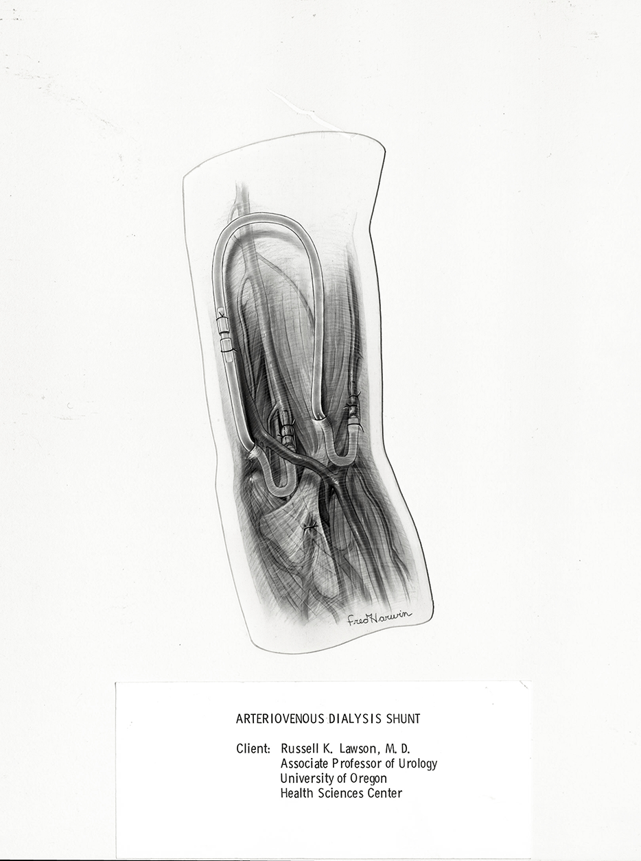 Arteriovenous Dialysis Shunt. Text: Dr. Russell Lawson for the University of Oregon Health and Sciences Center.