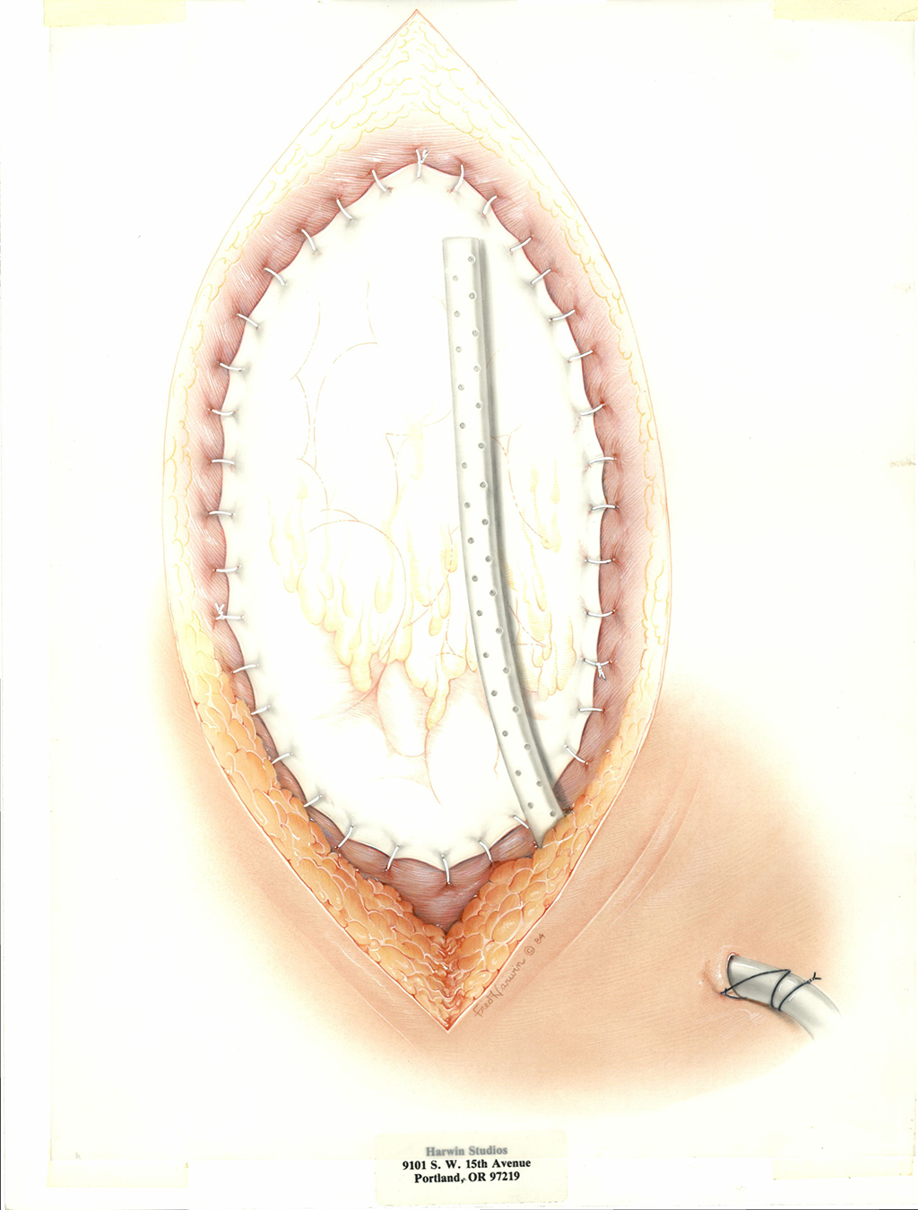 Gore-Tex illustration of soft tissue patch, 1984. Fred Harwin Collection [2022-014] 