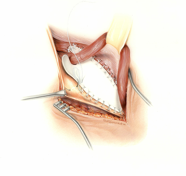 Gore-Tex illustration of the soft tissue patch