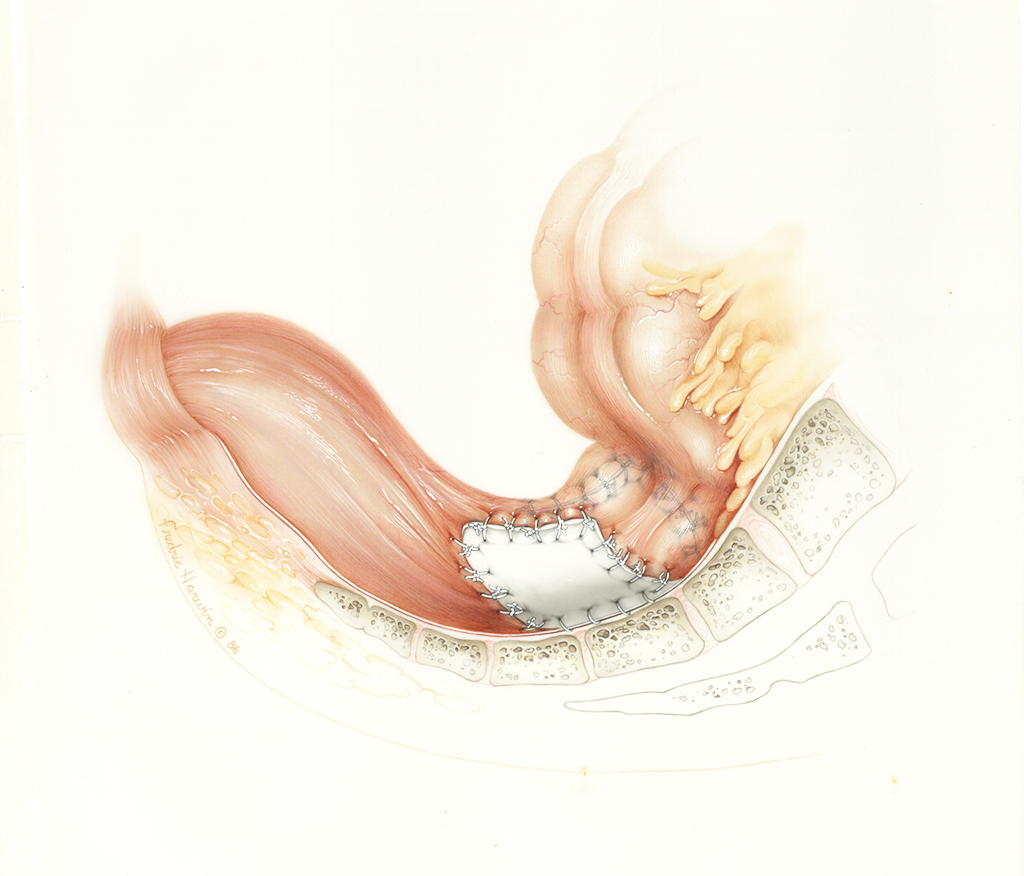 Gore-Tex suture illustration