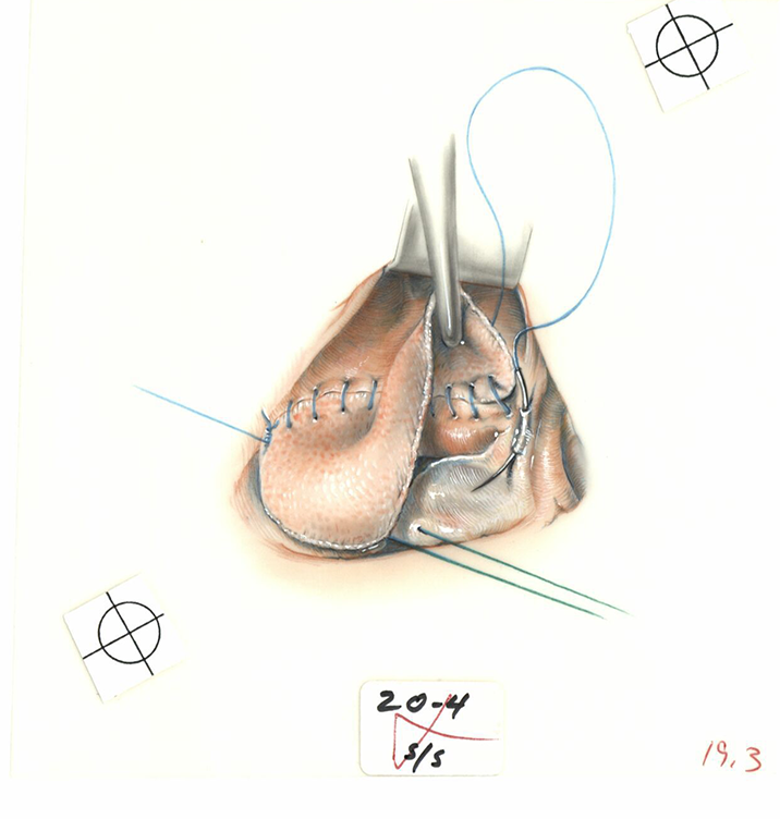 Color illustration of suture line near the coronary sinus