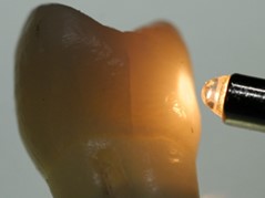 Tooth illuminated by light to highlight a crack