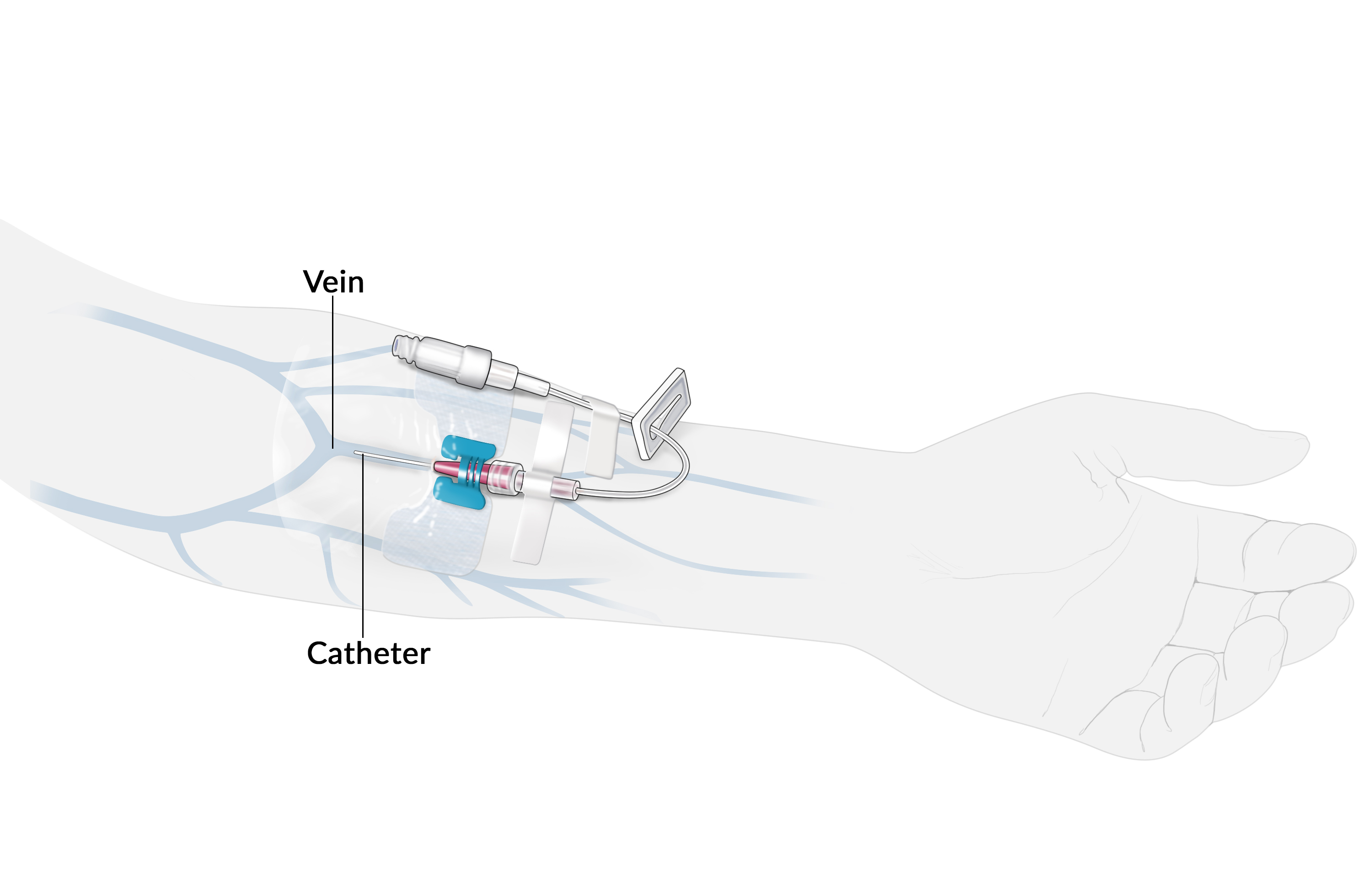 Peripheral venous catheter: An illustration of a peripheral venous catheter shows a tube inserted in a vein in an arm.