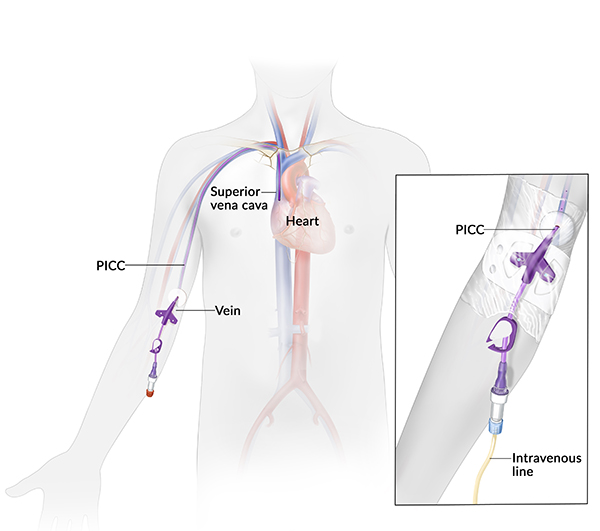 Peripherally inserted central catheter: An illustration of a peripherally inserted central catheter shows a long flexible tube inserted in the arm. The tube extends into the superior vena cava, a vein that leads to the heart. An inset illustration shows a close-up of the catheter where it is inserted in the arm, and its attached intravenous line.
