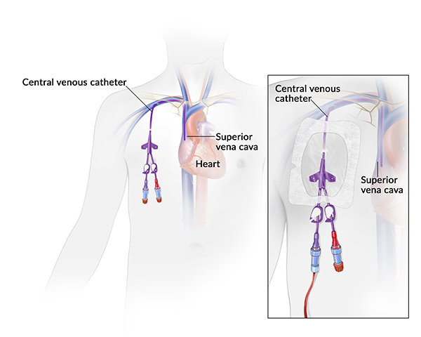 Central venous catheter: An illustration of a central venous catheter shows a long flexible tube inserted in the superior vena cava, a vein that leads to the heart. An inset illustration shows a closeup of the catheter taped to the chest.