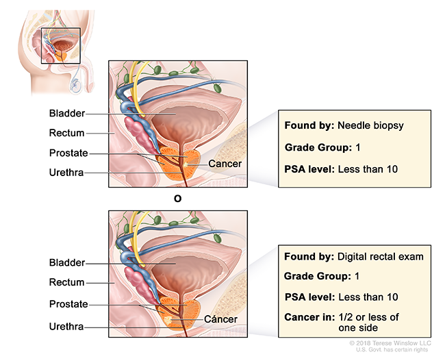 A pair of drawings show cancer in the prostate gland and label the prostate, bladder, rectum and urethra.