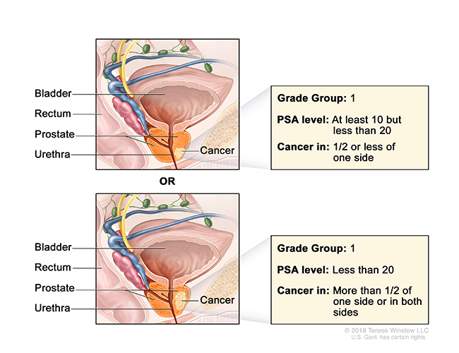 A pair of drawings show cancer in the prostate gland and label the prostate, bladder, rectum and urethra.