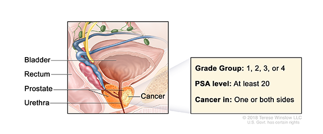 A drawing shows cancer in the prostate gland and labels the prostate, bladder, rectum and urethra.