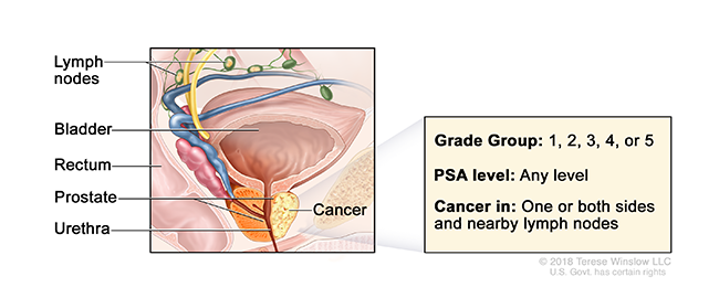 A drawing shows cancer in the prostate gland and labels the prostate, bladder, rectum, urethra and lymph nodes.