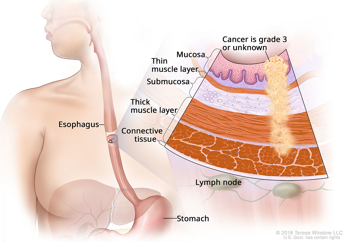 Stage IIA Adenocarcinoma of the Esophagus (esophageal cancer), with inset showing detail of the layers of the esophagus.