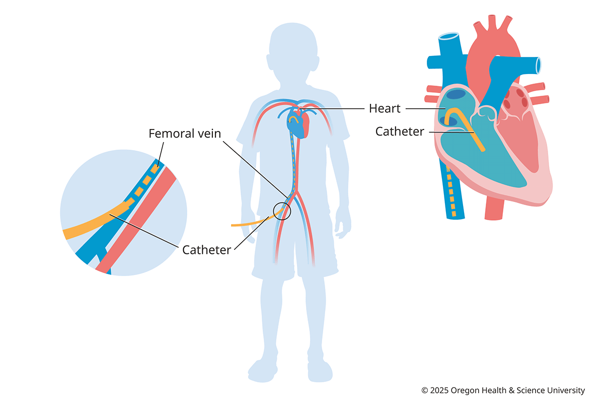 Diagram of heart catheterization in children