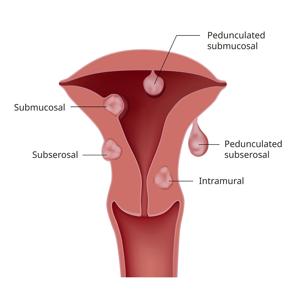 This graphic shows the different types of uterine fibroids and where they grow in the uterus.