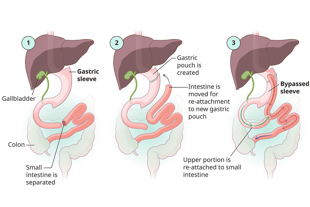 A graphic shows how a surgeon creates a small pouch from your stomach and then attaches the pouch to your small intestine in gastric bypass revisional surgery.