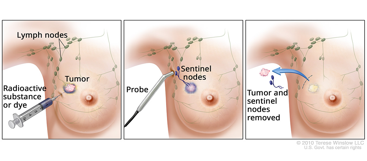 This drawing depicts lymph node biopsy in three panels. In the first panel, a radioactive dye is injected into a tumor in the breast. Next, a probe is inserted near the armpit to biopsy two lymph nodes. Finally, the tumor and two lymph nodes are removed.