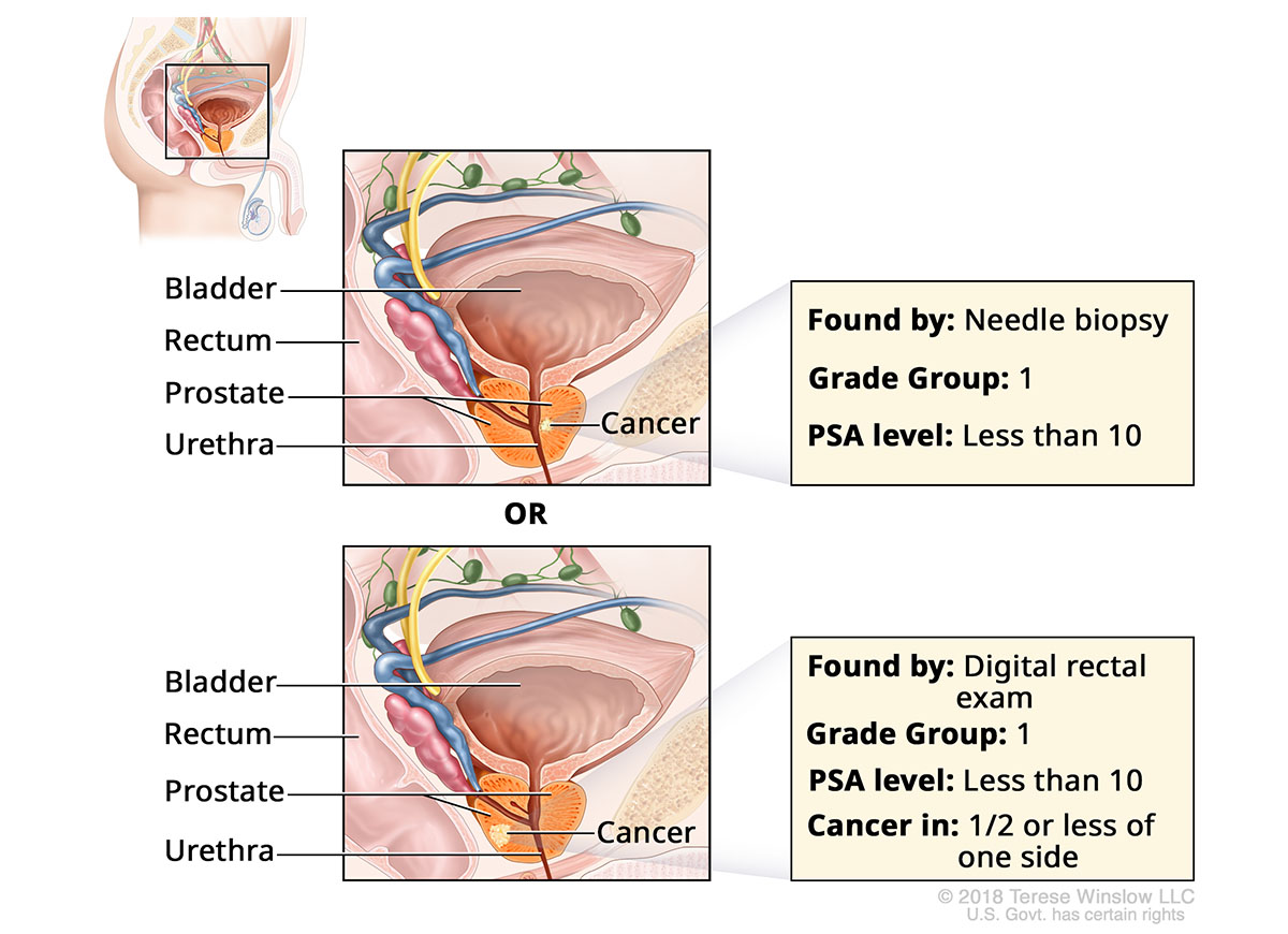 A pair of drawings show cancer in the prostate gland and label the prostate bladder, rectum and urethra.
