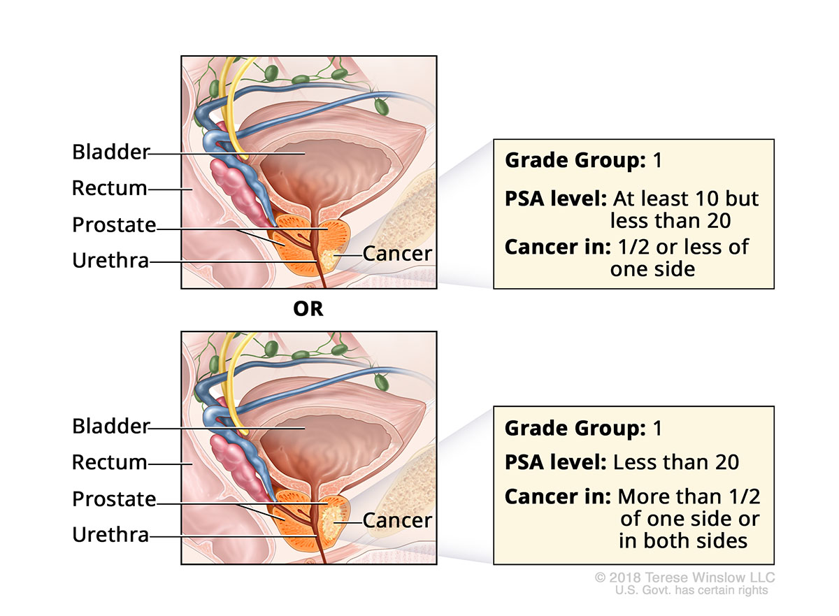  A pair of drawings show cancer in the prostate gland and label the prostate, bladder, rectum and urethra.