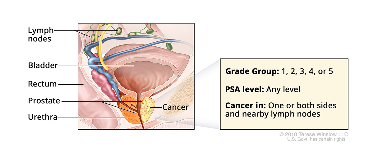 A drawing shows cancer in the prostate gland and labels the prostate, bladder, rectum, urethra and lymph nodes.